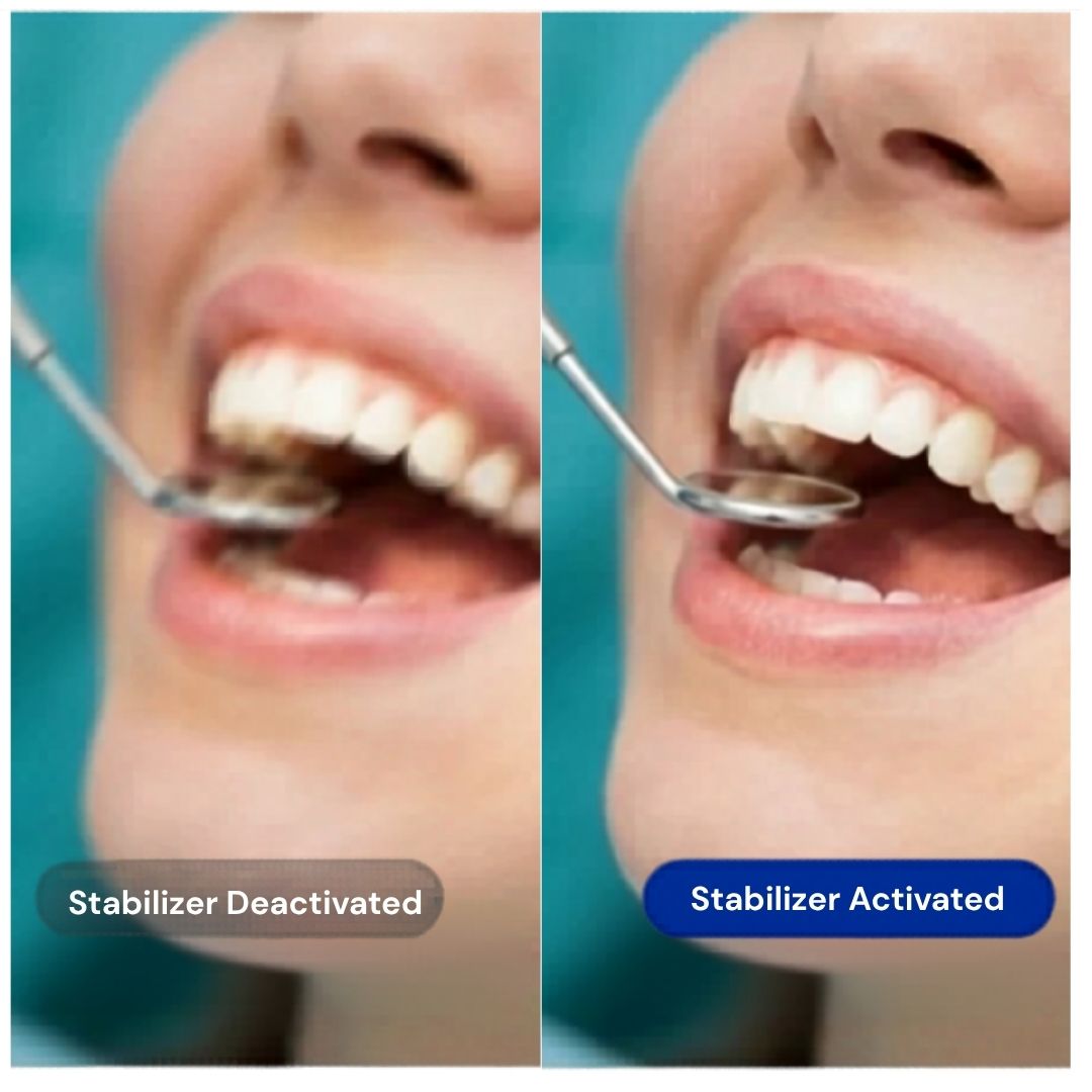 Image stabilization comparison: off vs on — sharper dental recording